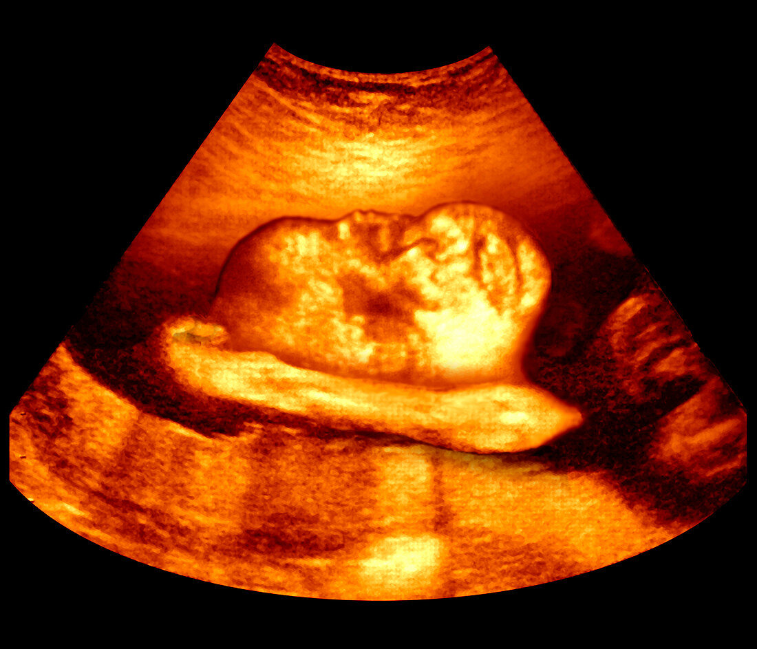 3-D foetal ultrasound