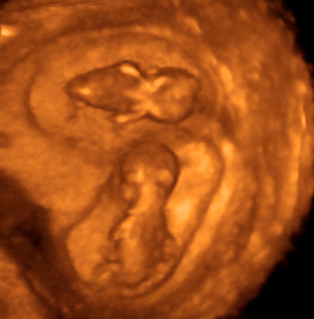 Twins,3-D ultrasound scan