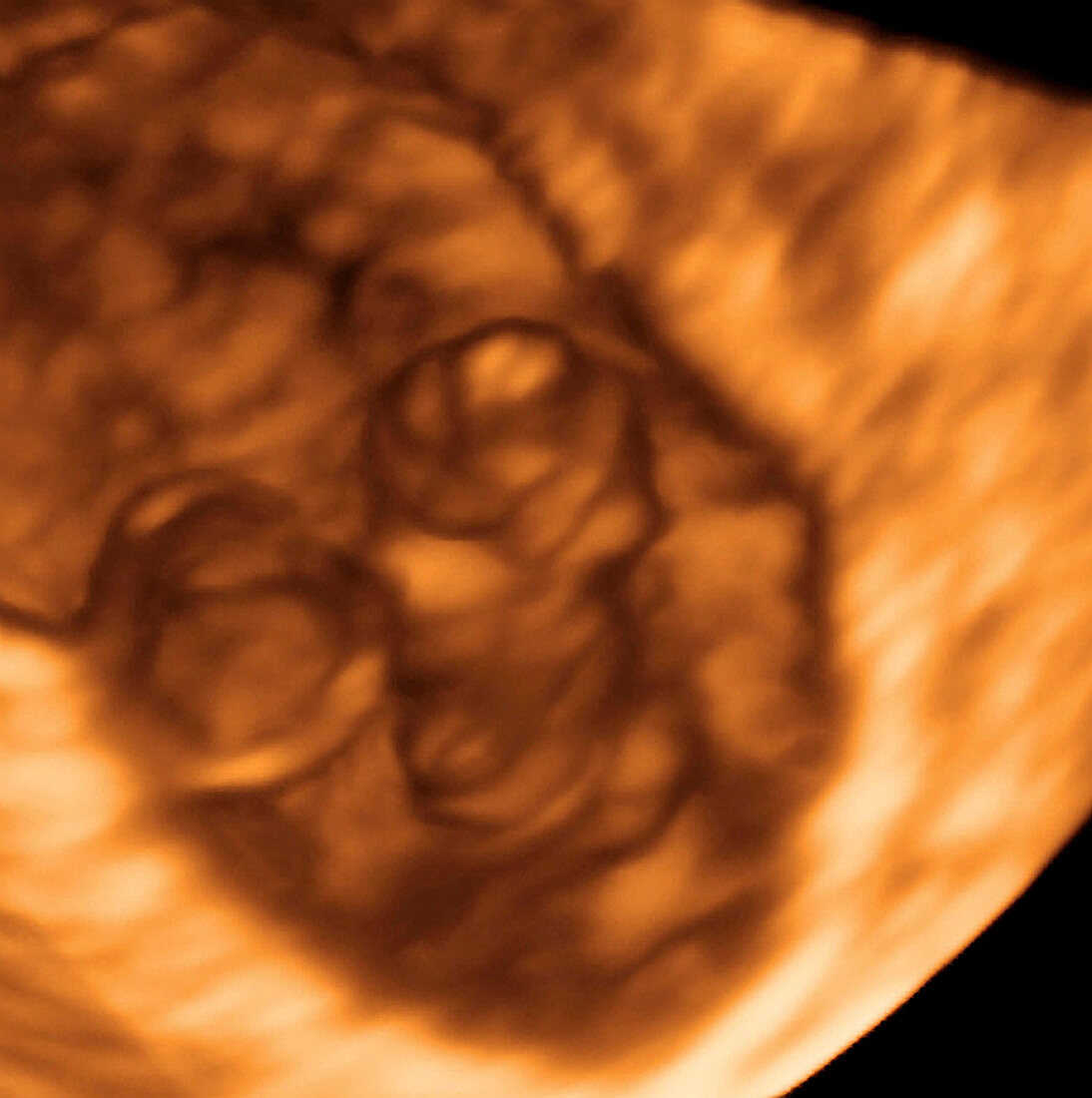 Embryo at 4 weeks,3-D ultrasound scan