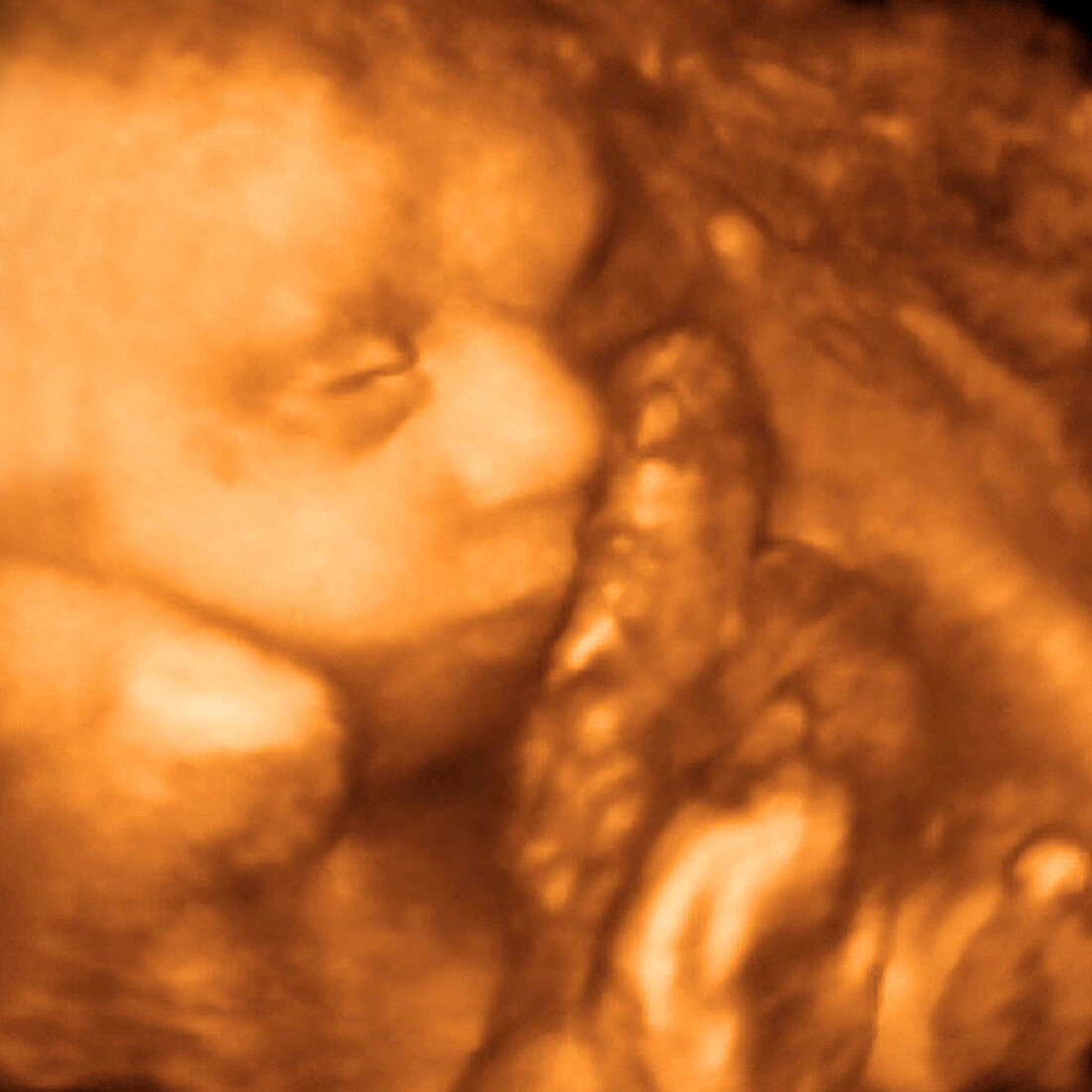 25 week foetus,3-D ultrasound scan