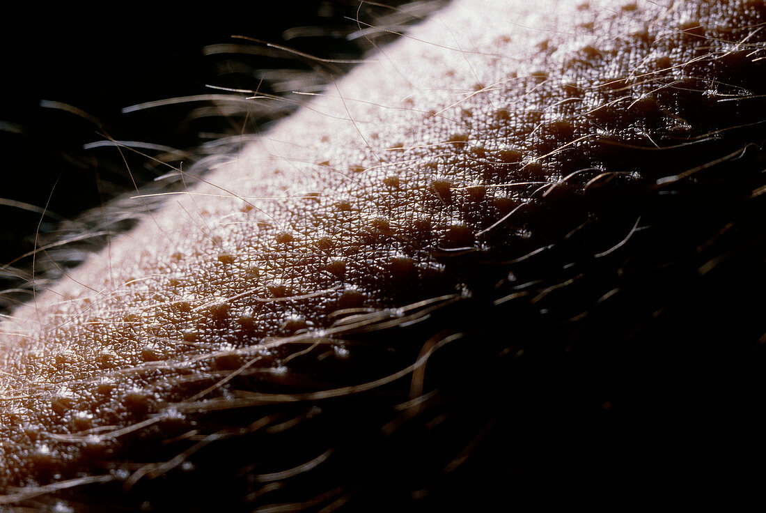 Macrophotograph of the skin showing goose -flesh