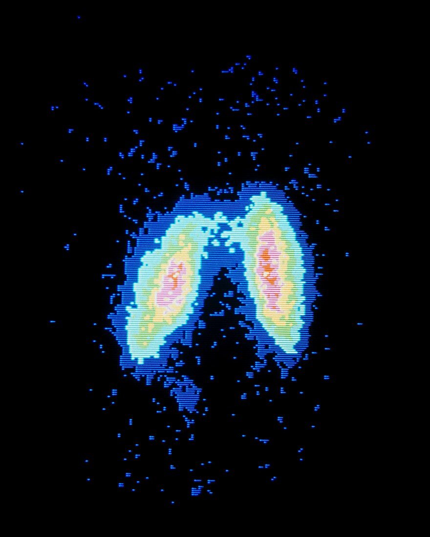 False-col gamma scintigram of normal thyroid gland