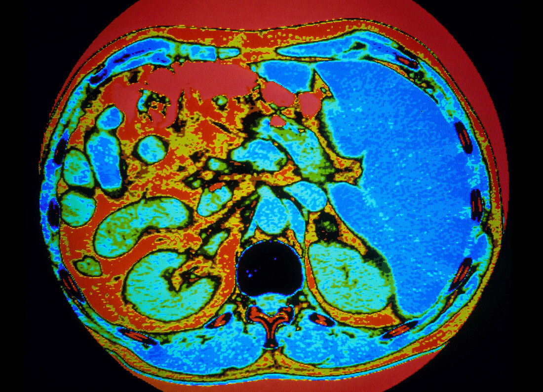 CT scan of human adrenal gland
