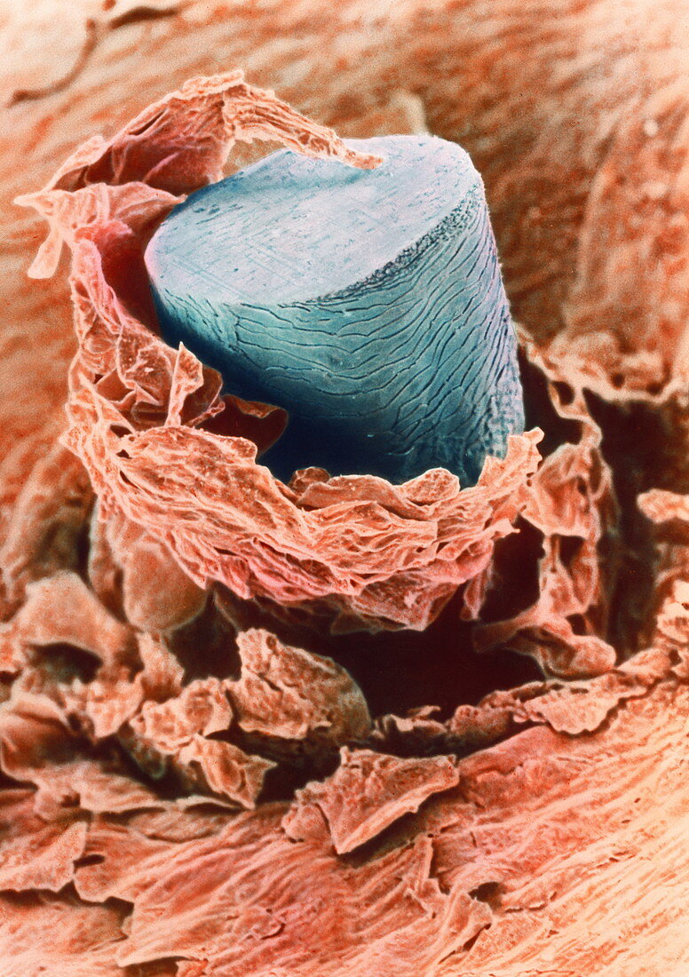 Coloured SEM of a shaved hair in the skin