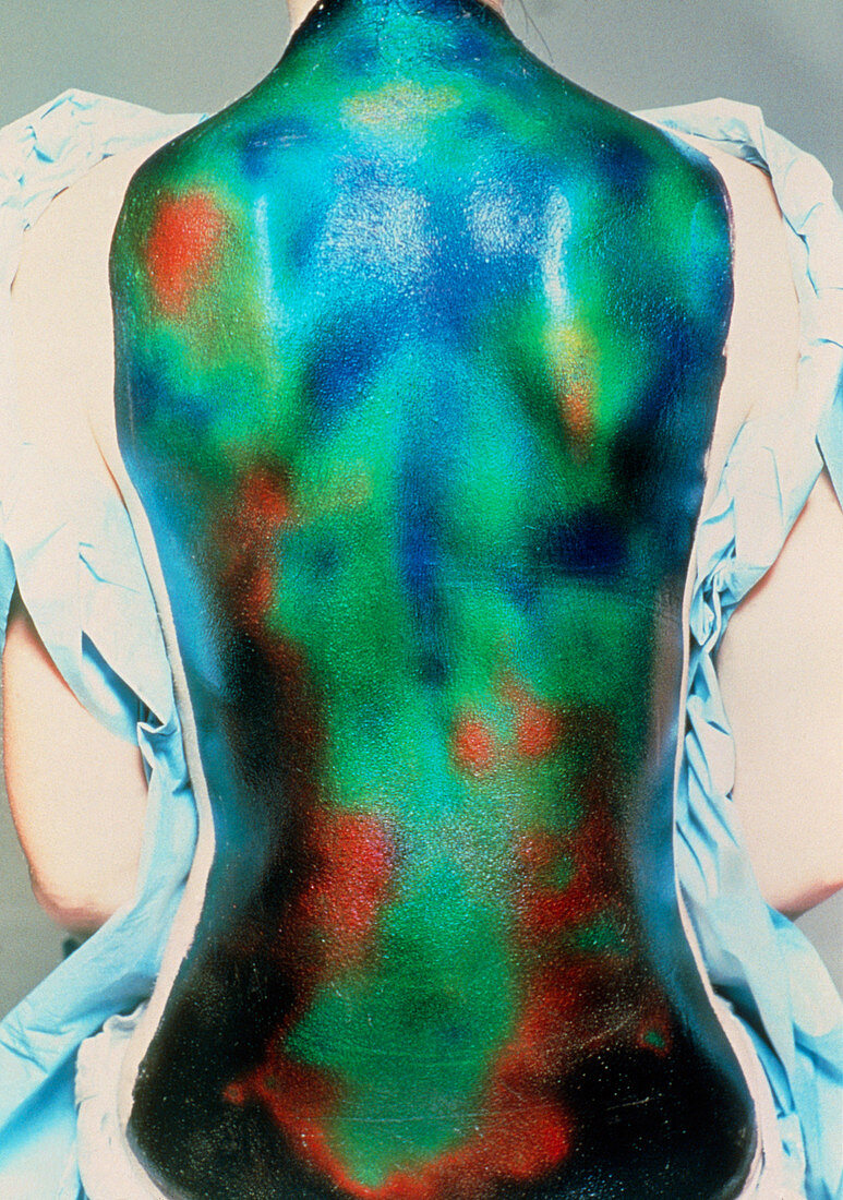 Liquid crystal thermography of a healthy back