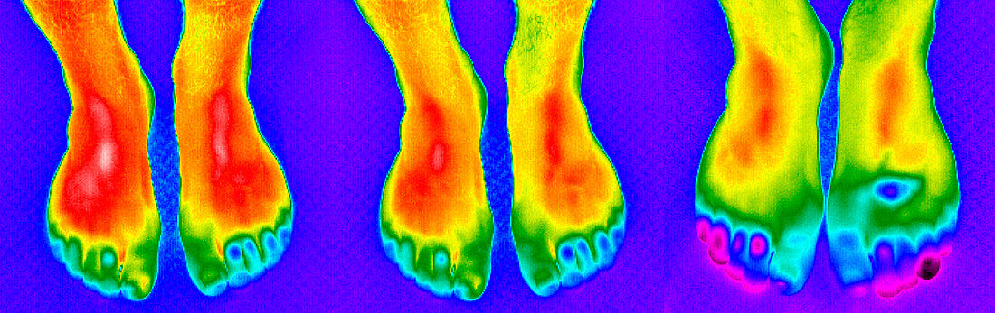 Thermogram of feet