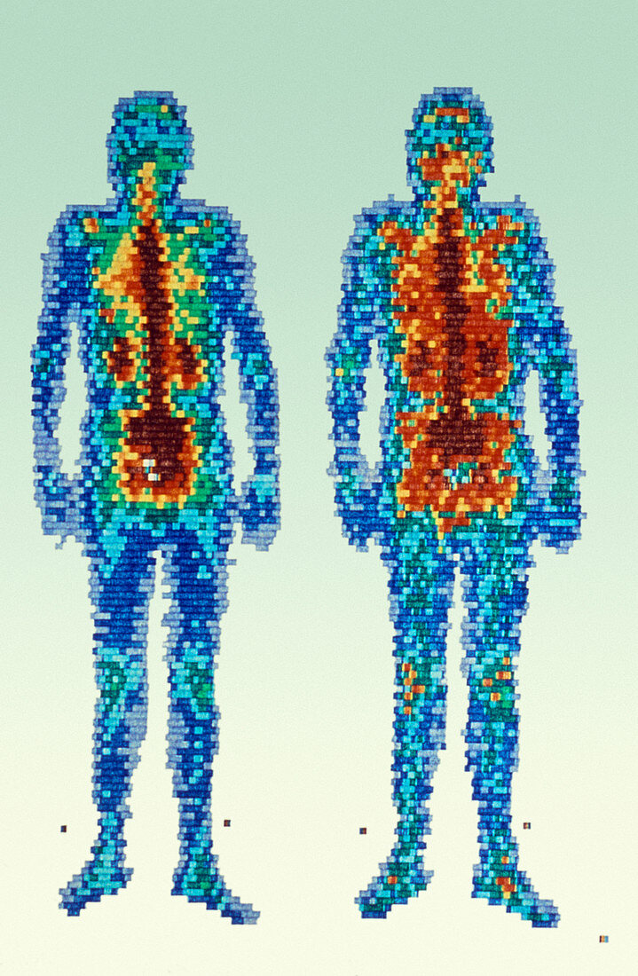 Whole-body scintigram of a healthy man