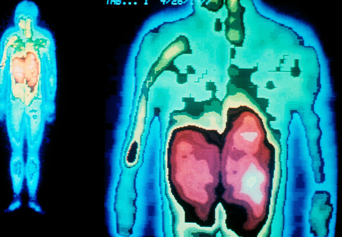 Gamma-camera scan showing stomach & liver