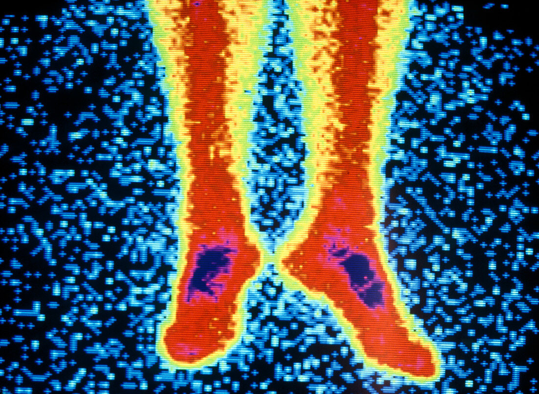 Coloured radionuclide bone scan of lower legs