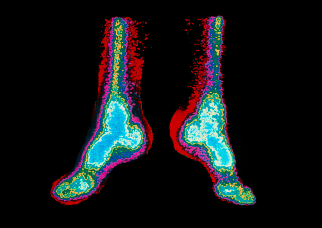 Coloured Gamma scan of lower leg and feet