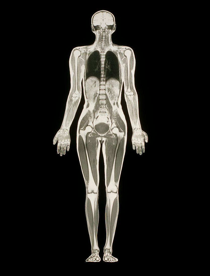 MRI scan of a whole human body (female)