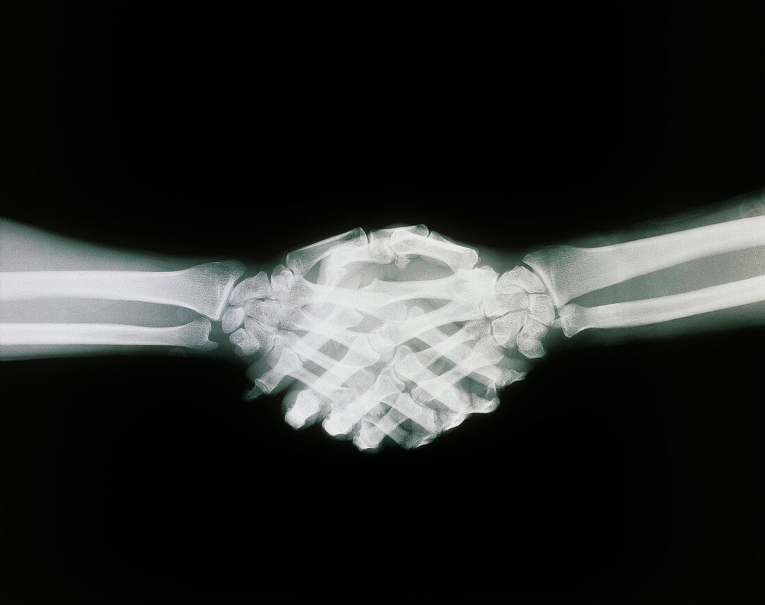 X-ray of a handshake