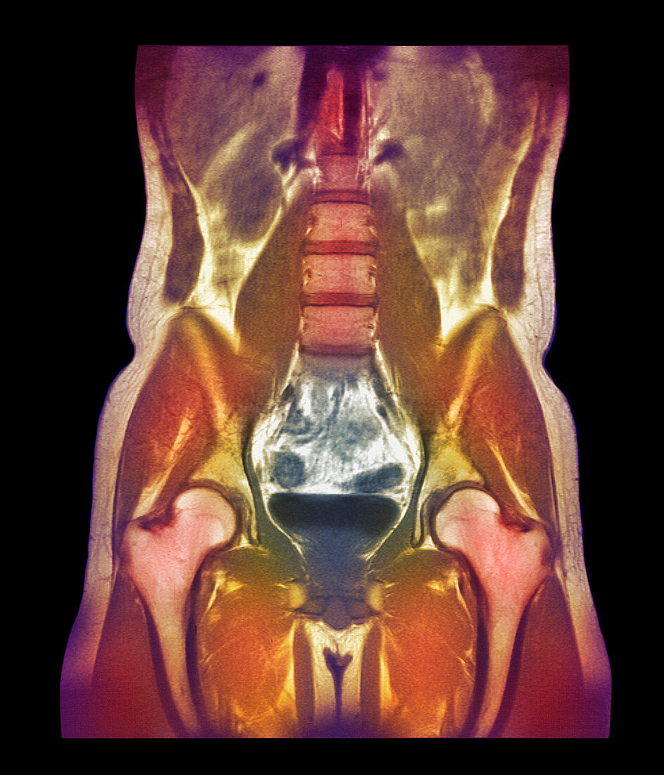 Abdominal scan,MRI