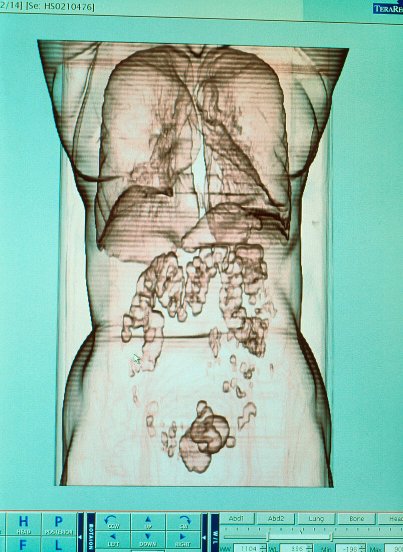 Female torso,EBT scan