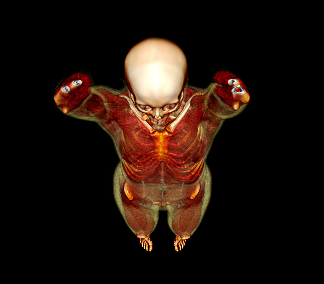 Female body,CT scan