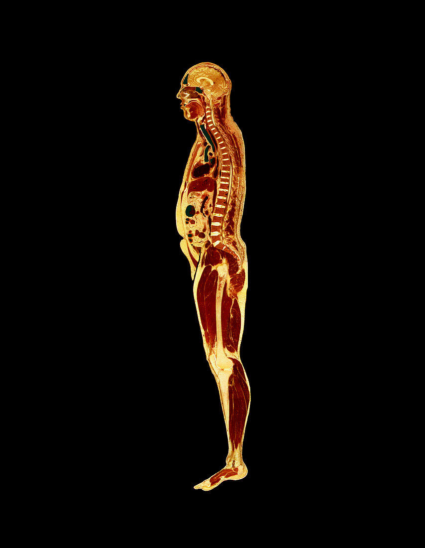 Visible Human Project: sectioned male body (side)