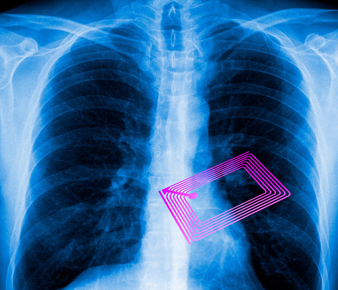 Security chip in a human chest