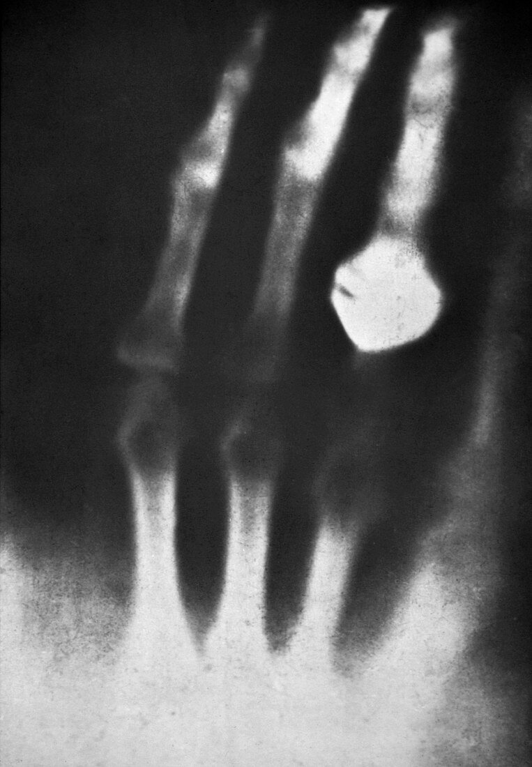 First ever human X-ray