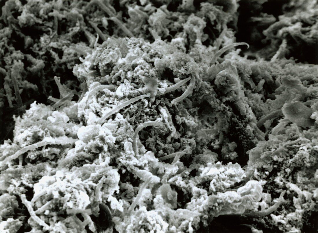 SEM of human duodenum with Strongyloides worms