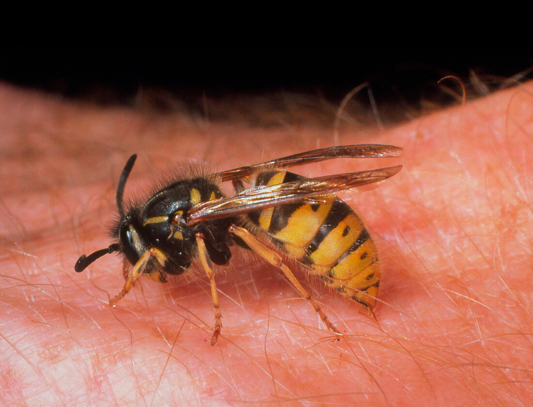 Common wasp (Vespula vulgaris) stinging human