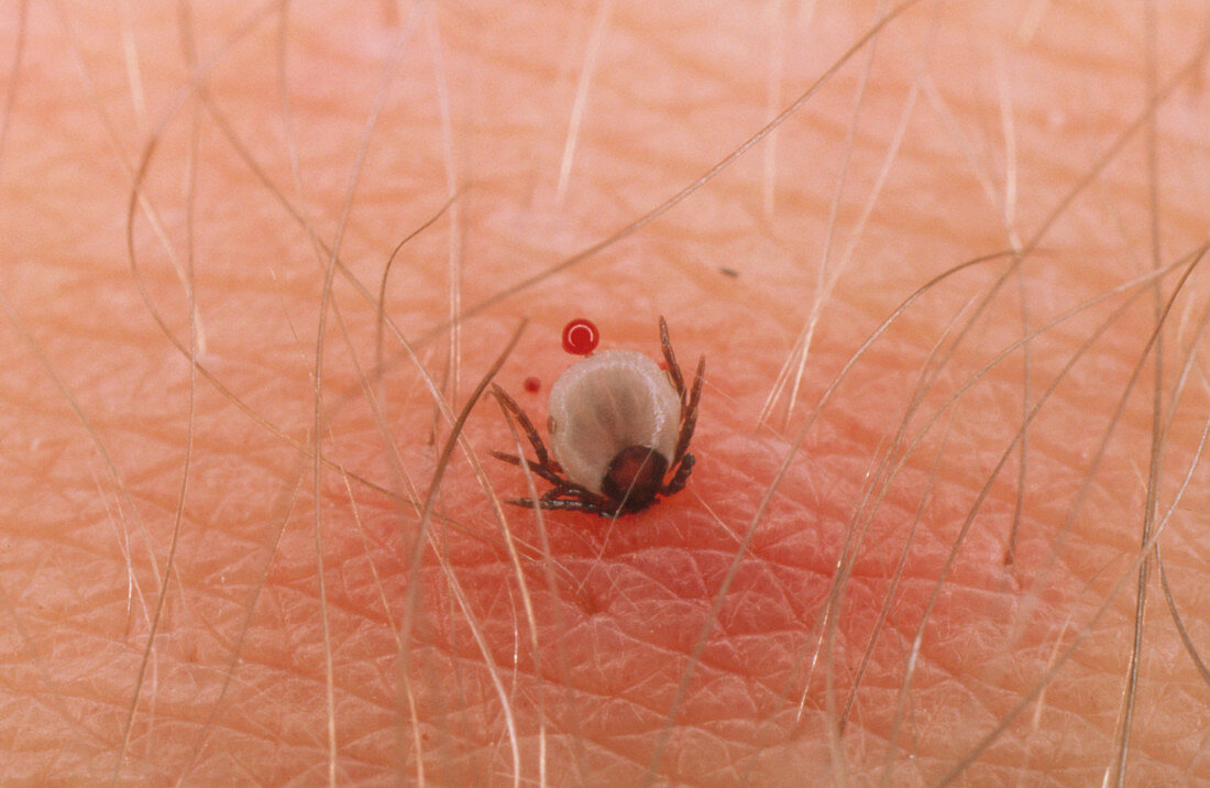 Female tick feeding on a human leg