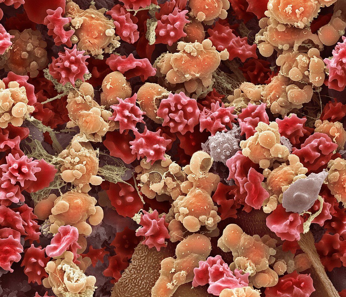 Cells from a urine infection,SEM