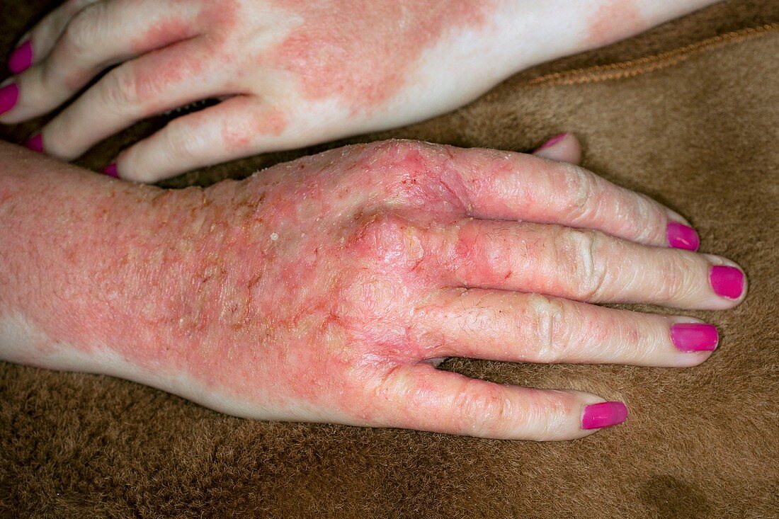 Allergic skin reaction to hand cream