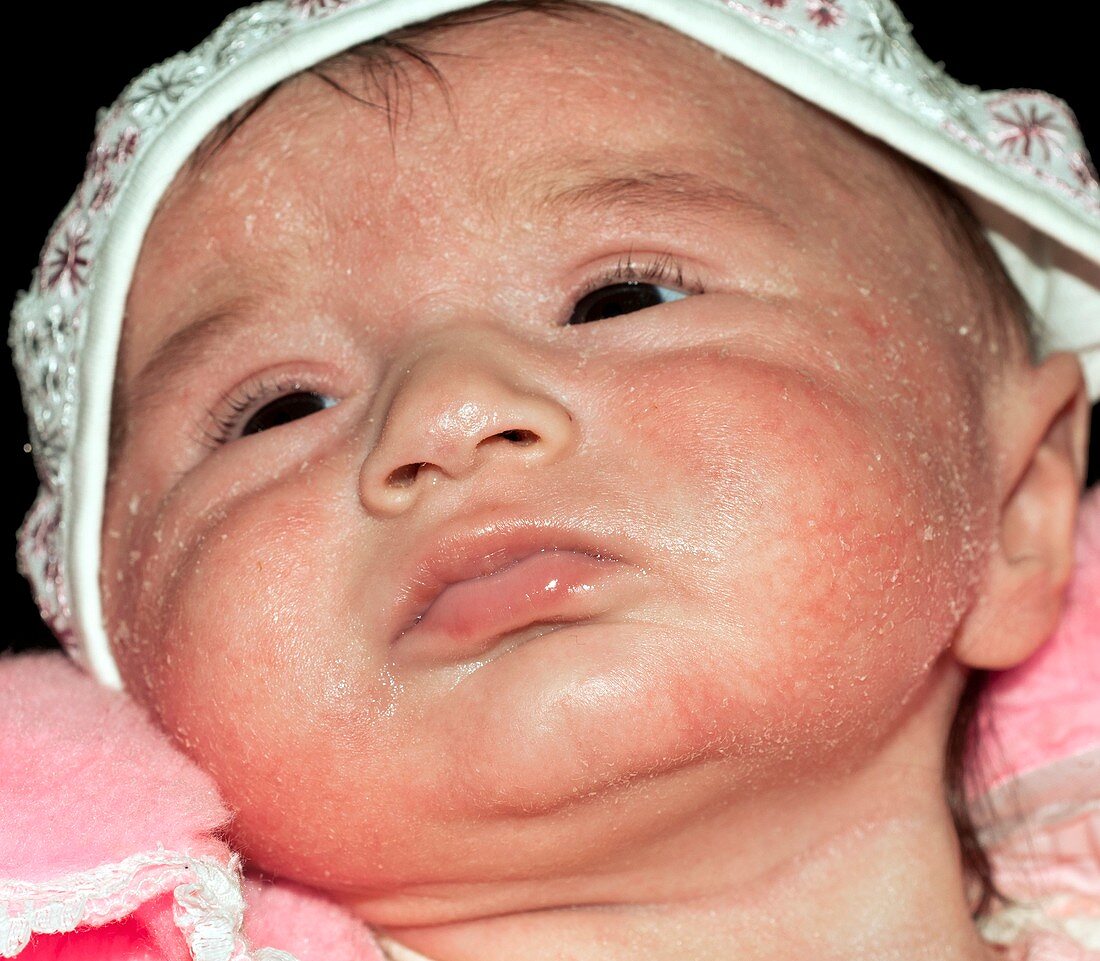 Atopic dermatitis on face of a baby