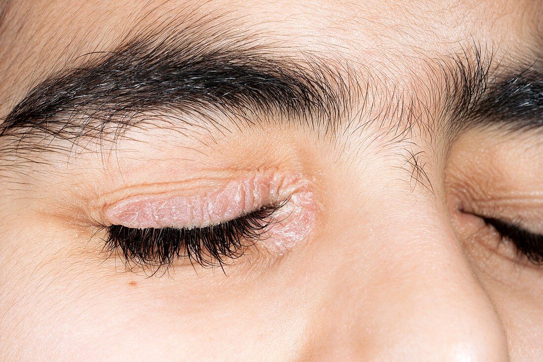 Psoriasis vulgaris on the eyelid