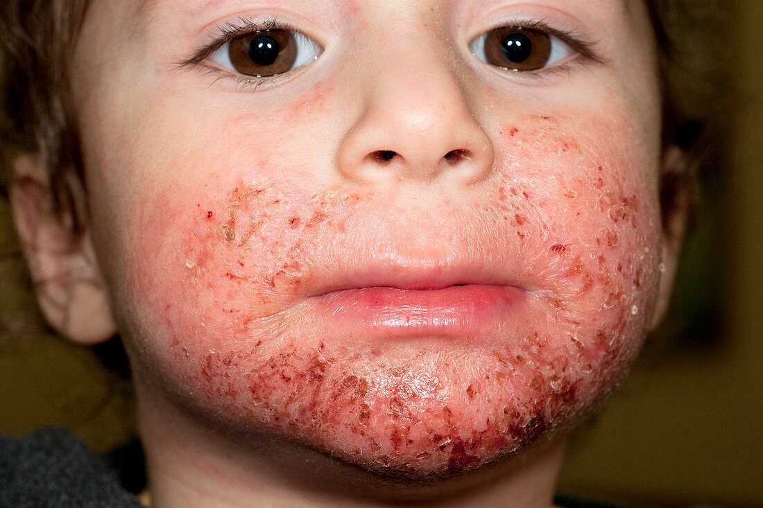 Atopic dermatitis on face of a child
