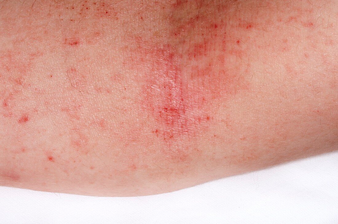 Eczema on the arm