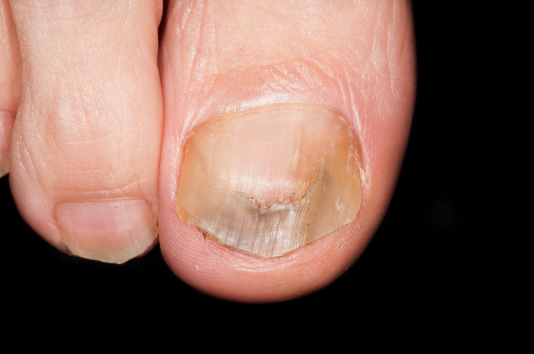 Treated onychomycosis nail infection