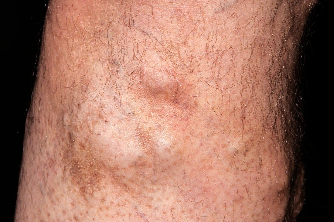 Varicose veins in the leg