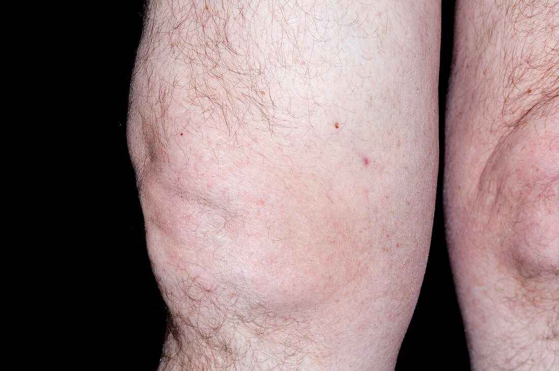 Swollen knee in osteoarthritis