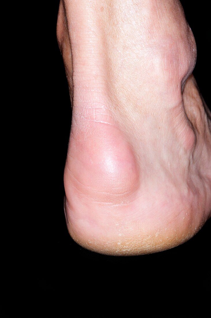 Bursitis of the heel of the foot