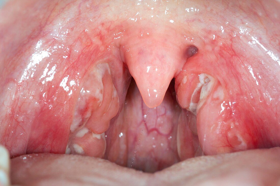 Viral tonsillitis