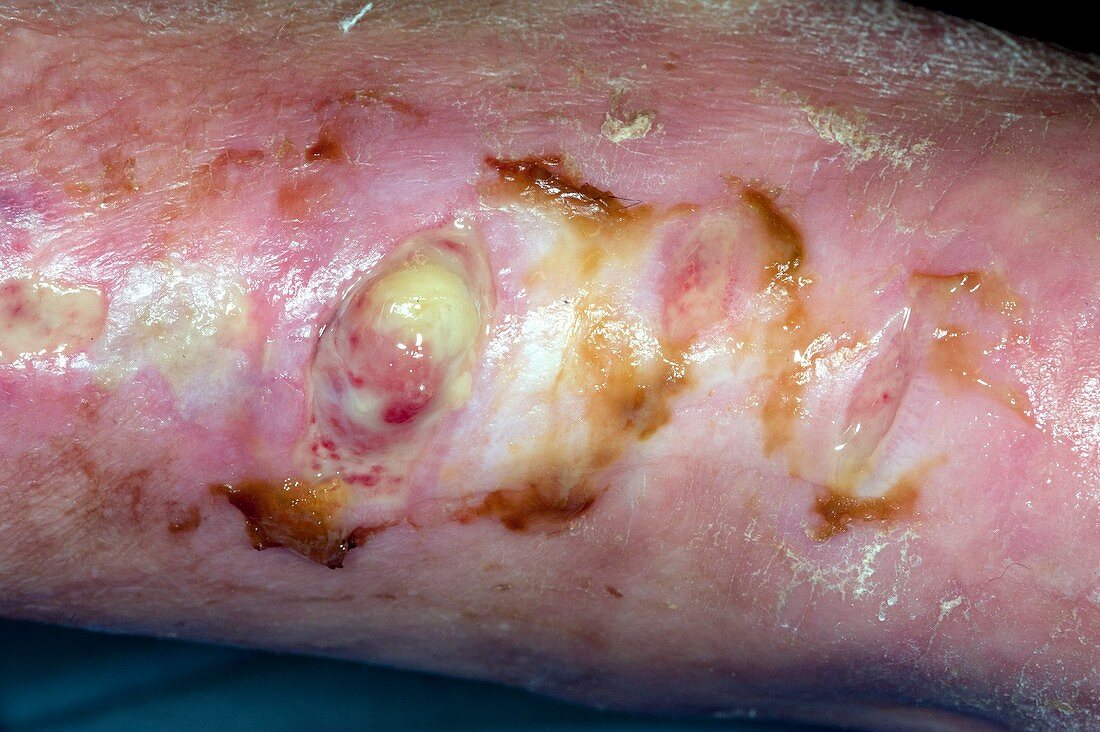 Infected ulcer on the foot