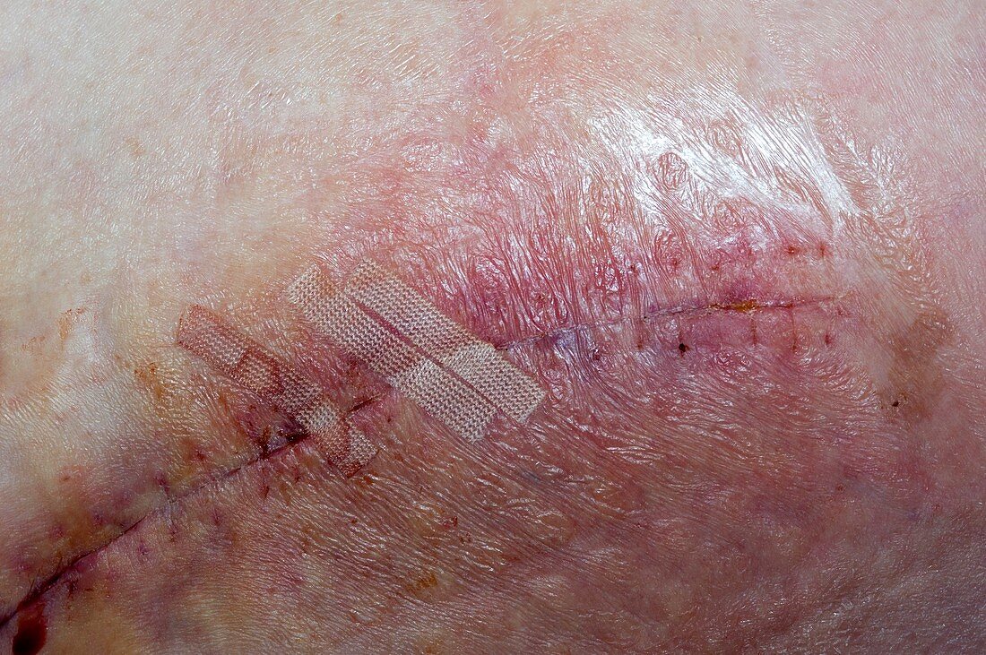 Wound infection after hip replacement