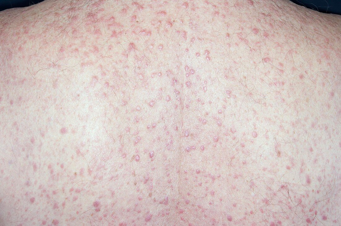 Eczema on the back