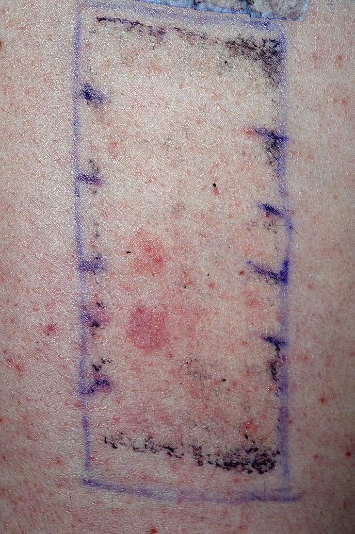 Patch testing for allergies