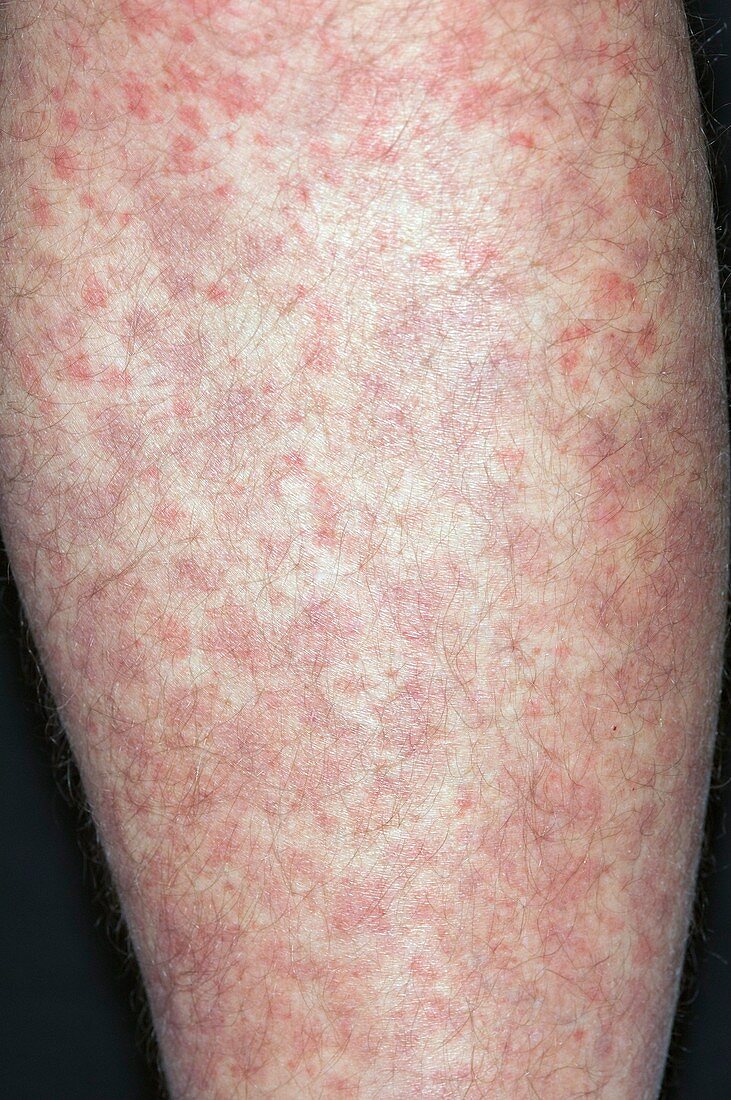 Allergic purpura on the leg
