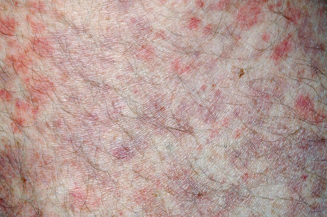Allergic purpura on the skin
