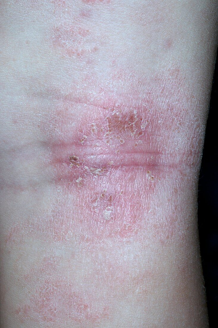 Atopic eczema on the knee