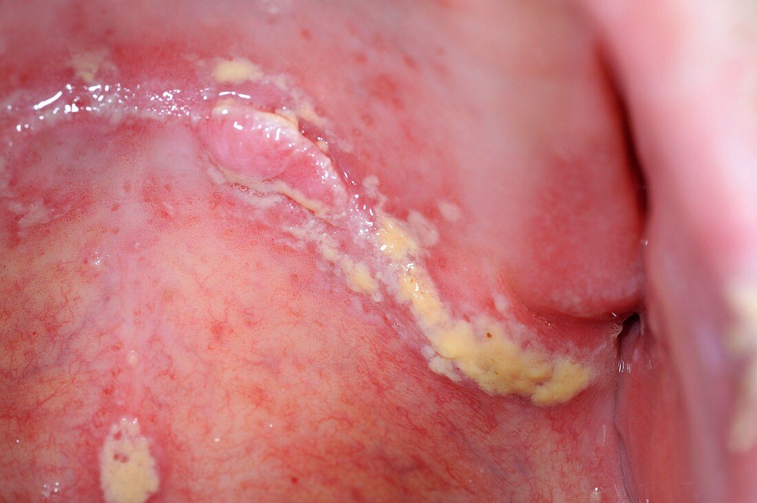 Oral thrush along the line of denture