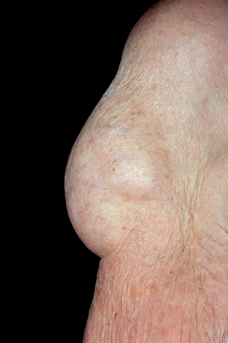 Lipoma on the upper arm