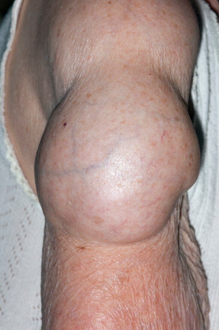 Lipoma on the upper arm