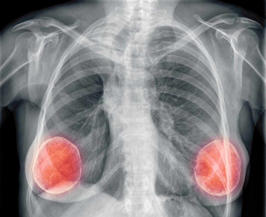 Breast implants,X-ray