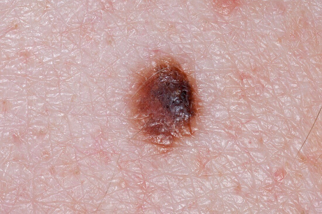 Junctional mole (naevus) on the skin