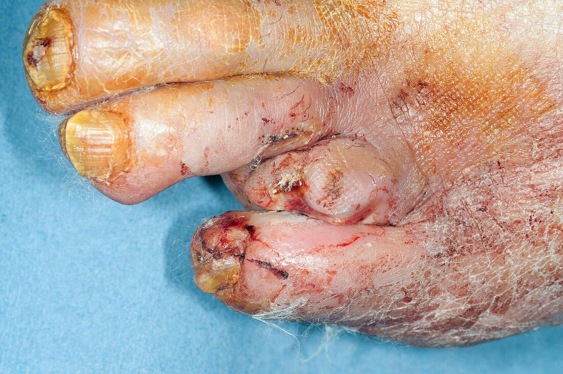 Diabetic foot with amputated toe