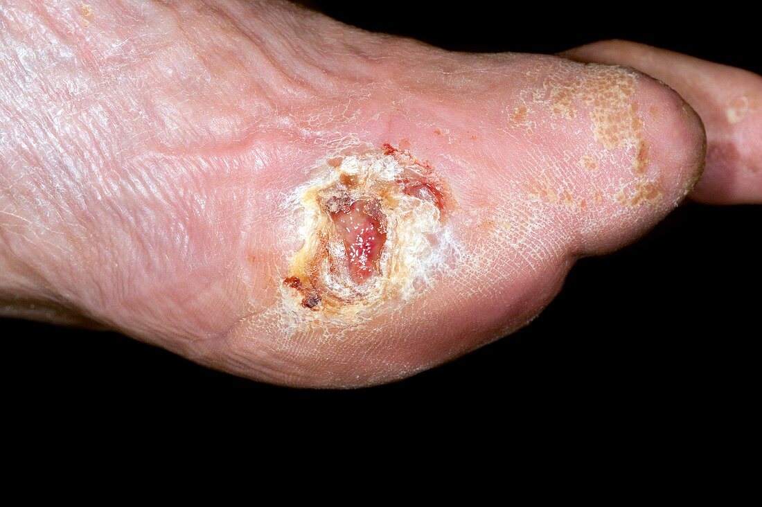 Diabetic foot with ulcer
